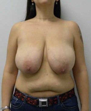 Breast Reduction Case 9259 Before Photo Breast Reduction