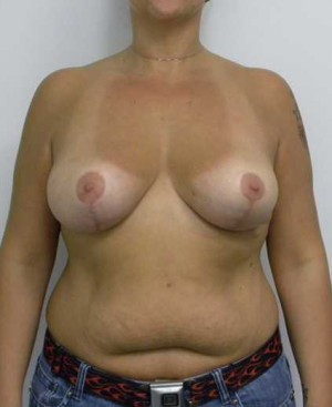 Breast Reduction Case 9259 After Photo Breast Reduction