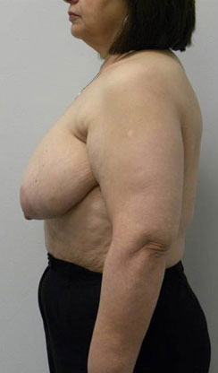 Breast Reduction Case 5807 Before Photo Breast Reduction