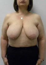 Breast Reduction