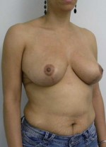 Breast Reduction