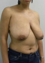 Breast Reduction