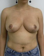 Breast Reduction