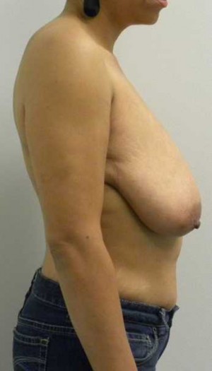 Breast Reduction