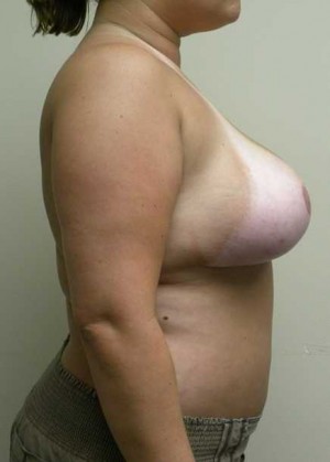 Breast Reduction