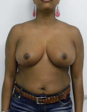 Breast Reduction