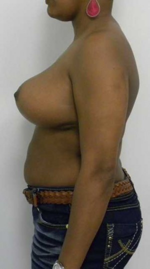 Breast Reduction