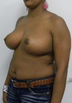 Breast Reduction