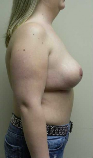 Breast Reduction Case 5838 After Photo Breast Reduction