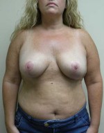 Breast Reduction