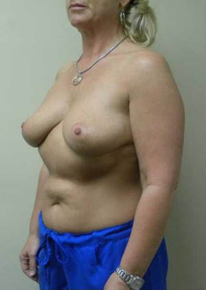 Breast Reduction Case 5855 After Photo Breast Reduction