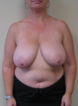 Breast Reduction Case 5855 Before Photo Breast Reduction