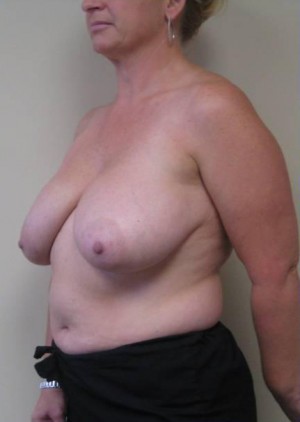 Breast Reduction Case 5855 Before Photo Breast Reduction