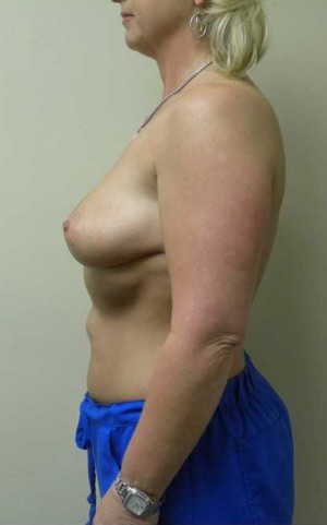 Breast Reduction Case 5855 After Photo Breast Reduction