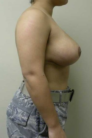 Breast Reduction Case 9270 After Photo Breast Reduction