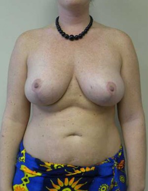 Breast Reduction Case 5882 After Photo Breast Reduction