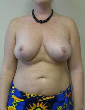 Breast Reduction