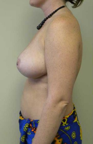 Breast Reduction Case 5882 After Photo Breast Reduction