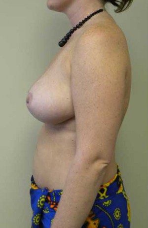 Breast Reduction