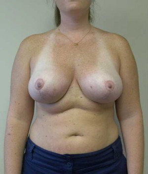 Breast Reduction