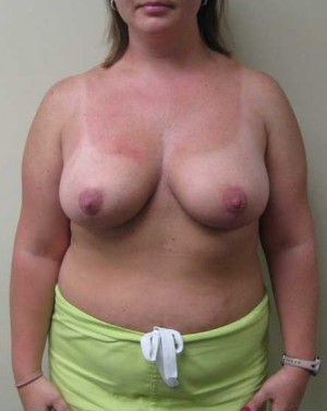 Breast Reduction