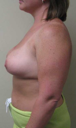 Breast Reduction Case 5935 After Photo Breast Reduction