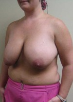 Breast Reduction