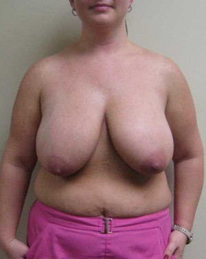 Breast Reduction Case 5935 Before Photo Breast Reduction