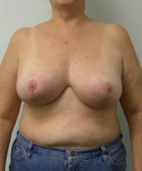 Breast Lift Case 5540 After Photo Breast Lift