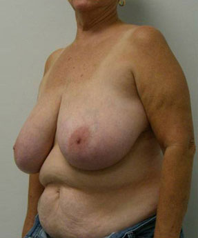 Breast Lift Case 5540 Before Photo Breast Lift