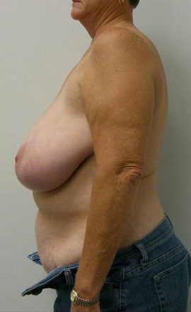 Breast Lift Case 5540 Before Photo Breast Lift