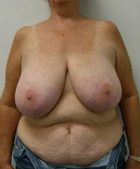 Breast Reduction Case 5776 Before Photo Breast Reduction