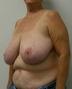 Breast Reduction Case 5776 Before Photo Breast Reduction