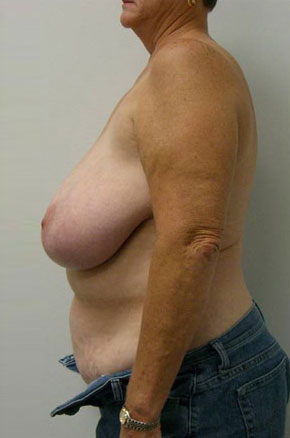 Breast Reduction Case 5776 Before Photo Breast Reduction