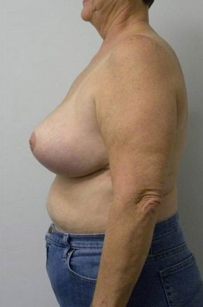 Breast Reduction Case 5776 After Photo Breast Reduction
