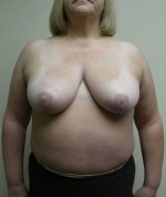 Breast Reduction