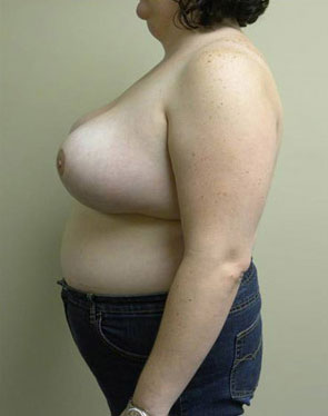 Breast Reduction Case 5875 After Photo Breast Reduction