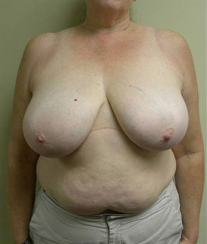 Breast Reduction Case 9274 Before Photo Breast Reduction