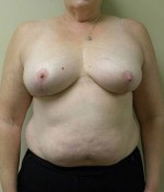 Breast Reduction