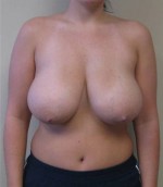 Breast Reduction
