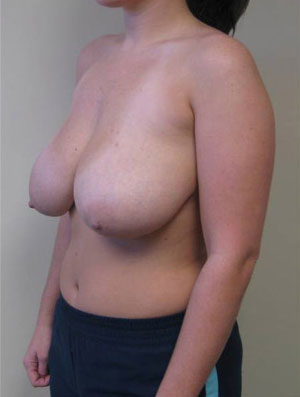 Breast Reduction Case 5897 Before Photo Breast Reduction