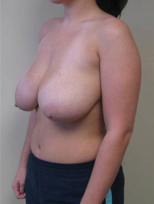 Breast Reduction