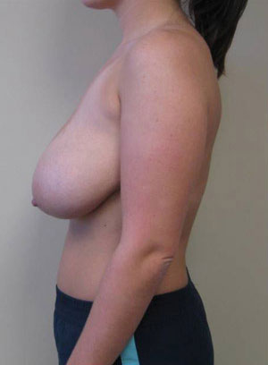 Breast Reduction Case 5897 Before Photo Breast Reduction