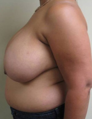Breast Reduction Case 5928 Before Photo Breast Reduction