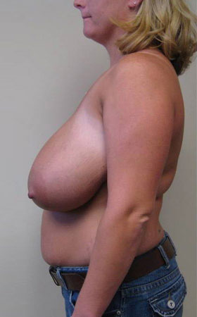 Breast Reduction