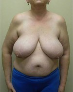 Breast Reduction