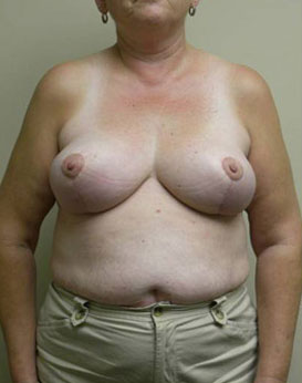 Breast Reduction Case 5949 After Photo Breast Reduction