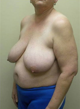 Breast Reduction Case 5949 Before Photo Breast Reduction