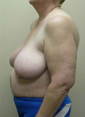 Breast Reduction Case 5949 Before Photo Breast Reduction