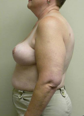 Breast Reduction Case 5949 After Photo Breast Reduction